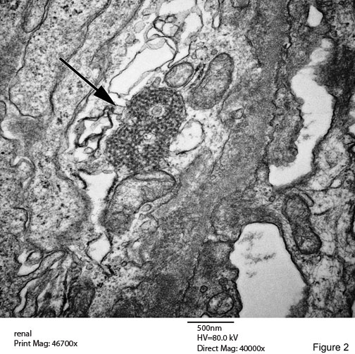 Tubuloreticular Inclusions fig. 2