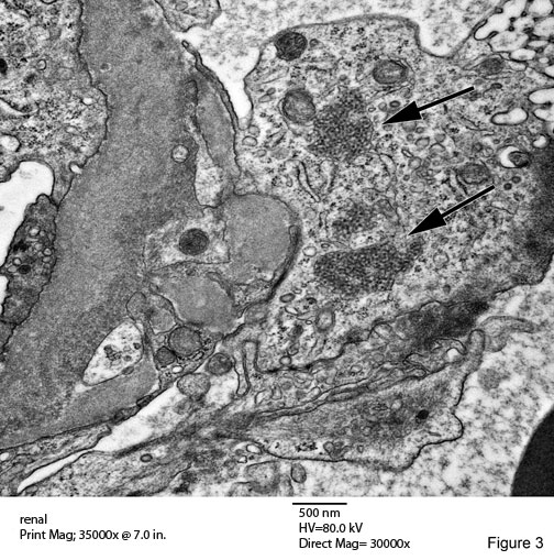 Tubuloreticular Inclusions Fig. 3