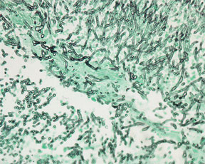 Grocott’s Methenamine Silver Nitrate  -  Microwave Procedure