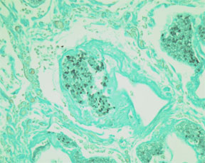 Grocott’s Methenamine Silver Nitrate  -  Microwave Procedure 2